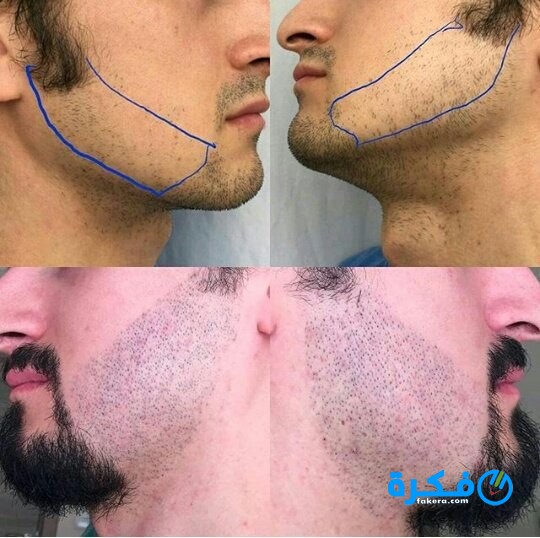 سبب القشور بعد زراعة الشعر 2 D0jiwLMW0AEZGPa