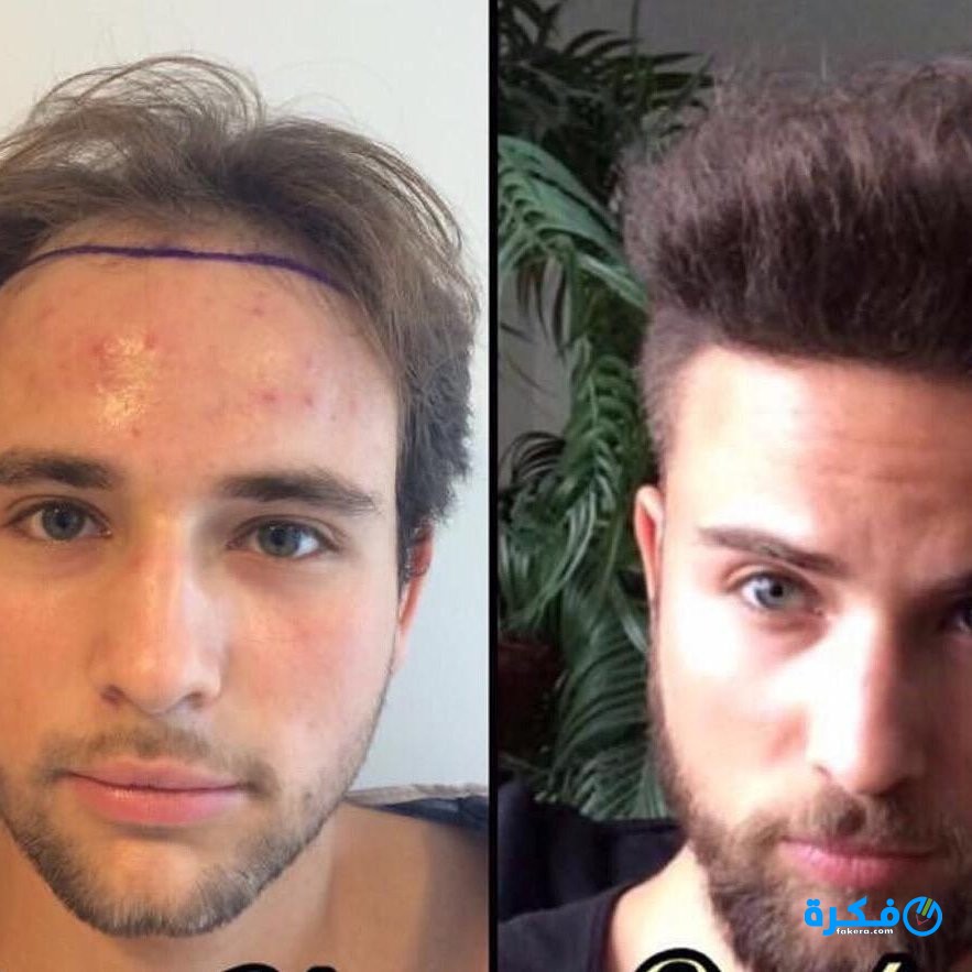 أسعار واماكن زراعة الشعر في السعودية 1446 3 Dz6wIuoWsAAfSuf