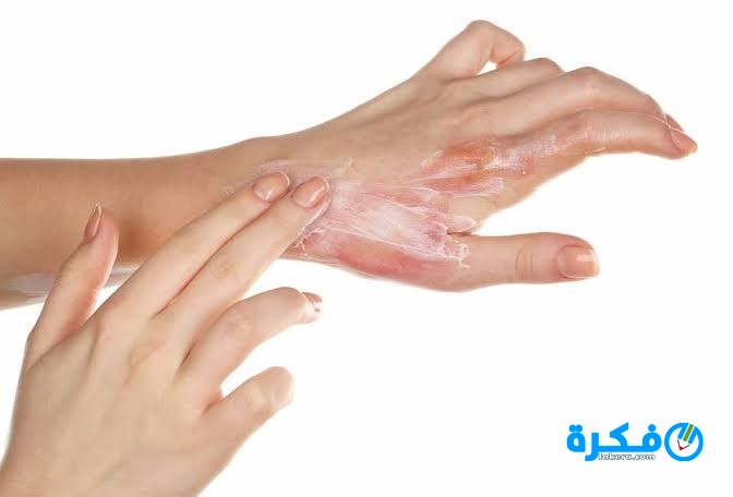 كريم بينتابورن Pentaburn لعلاج الحروق والجروح 2 images 1 2