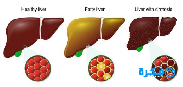 التليف الكبدى
