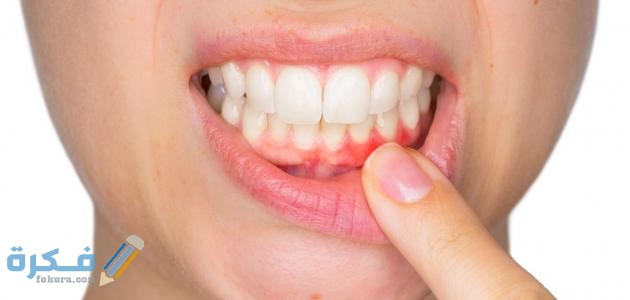 التهاب اللثة والانتفاخ