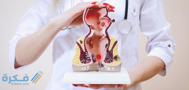 ما هو أفضل مرهم لعلاج البواسير الخارجية ؟