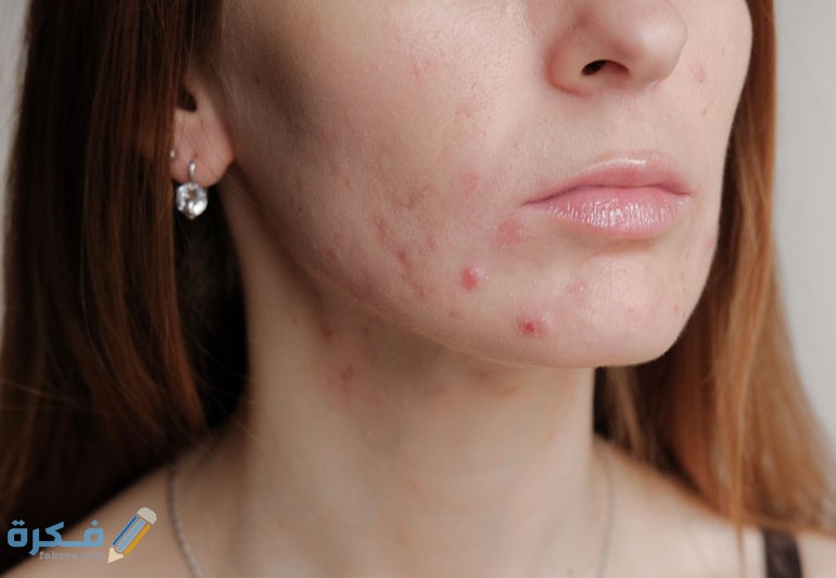 acneCare 1167910623 770x533 1