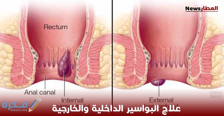 البواسير الداخلية والخارجية 780x405 1
