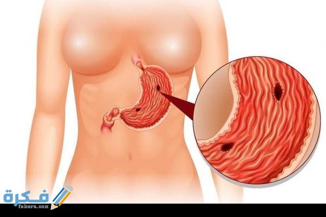 تجربتي مع علاج قرحة المعدة stomach ulcer diagrama a