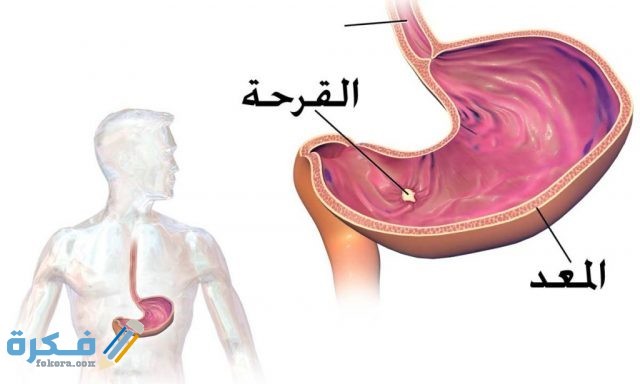 تجربتي مع علاج قرحة المعدة المعدة 1024x614 1