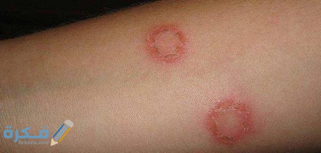 بيوتاكيسمارك علاج الفطريات الجلدية