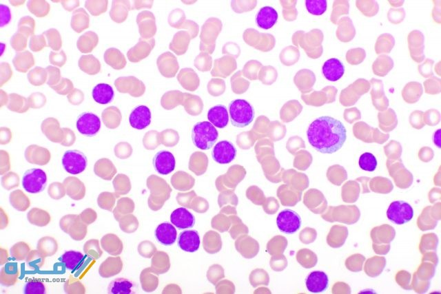 اسباب نقص خلايا الدم البيضاء اسباب نقص خلايا الدم البيضاء