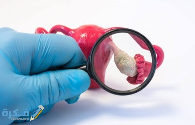 ما هي التحاليل التي تكشف تكيس المبايض؟ 