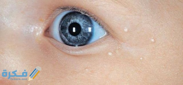 بقع بيضاء في الوجه عند الأطفال الرضع أسبابها وطرق علاجها بقع بيضاء في الوجه عند الأطفال الرضع أسبابها وطرق علاجها