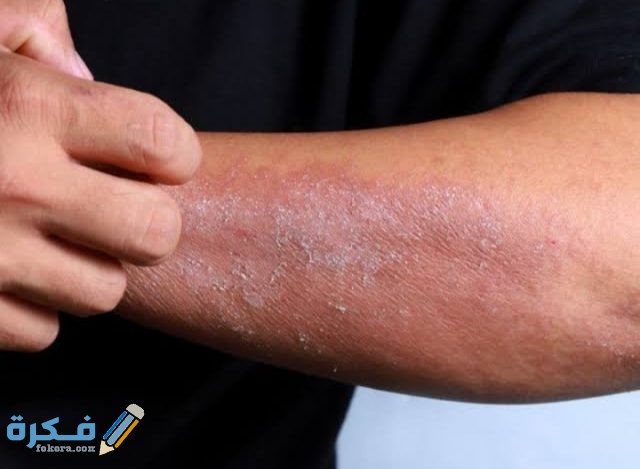 اسم أفضل مضاد حيوي لعلاج التهابات الجلد اسم أفضل مضاد حيوي لعلاج التهابات الجلد