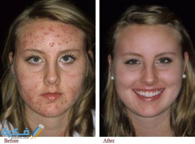 متى يبدأ مفعول حبوب كوراكني متى يبدأ مفعول حبوب كوراكني