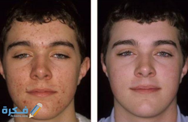 متى يبدأ مفعول حبوب كوراكني متى يبدأ مفعول حبوب كوراكني