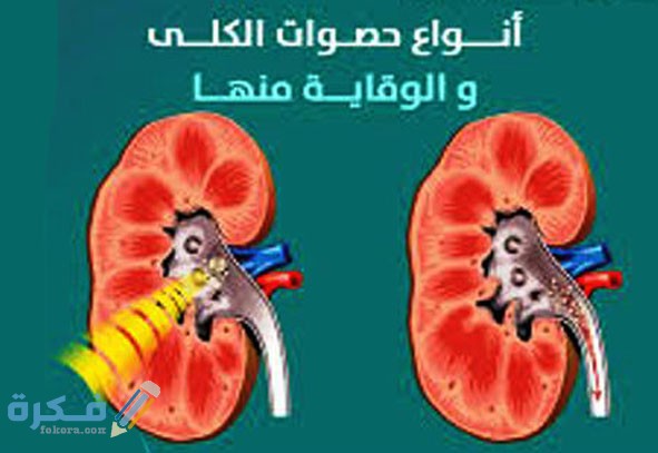 علاج حصوات الكلى الصغيرة