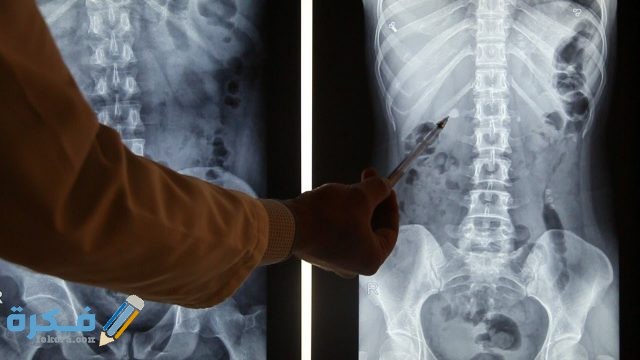 طرق تشخيص حصوات الكلى طرق تشخيص حصوات الكلى