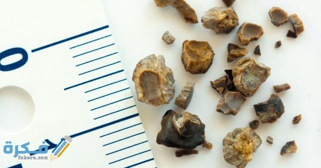 طرق علاج حصوات الكلى الصغيرة طرق علاج حصوات الكلى الصغيرة
