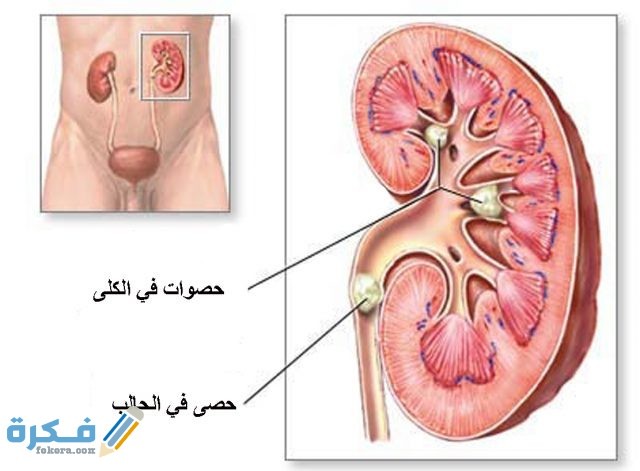 ما هي حصوات الكلى ما هي حصوات الكلى