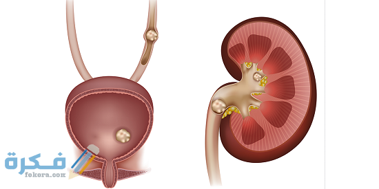 نصائح للتخلص من حصوات الكلى منزليا نصائح للتخلص من حصوات الكلى منزليا