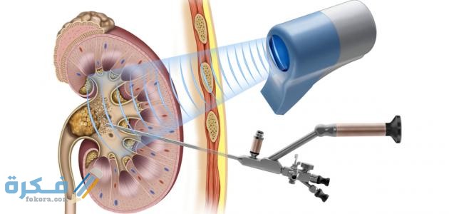 طرق علاج حصوات الكلى الكبيرة طرق علاج حصوات الكلى الكبيرة