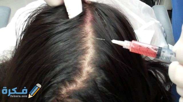 كيفية احياء بصيلات الشعر كيفية احياء بصيلات الشعر