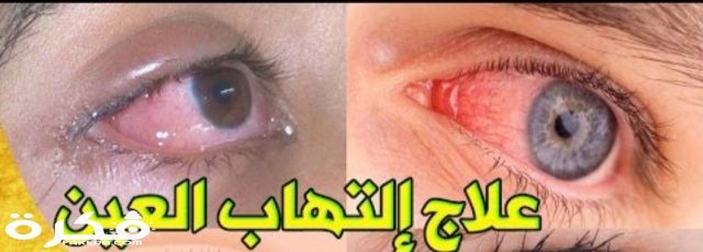 كلومسين Klomycine IMG ٢٠٢٠٠٤٠٥ ٠٦٢٧٣٣