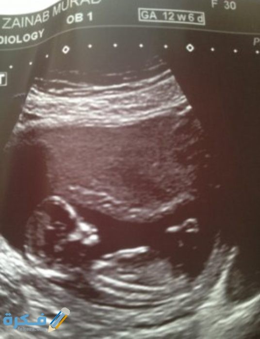 معرفة نوع الجنين من شكل الجمجمة IMG ٢٠٢٠٠٤٢٦ ١٤٠٧٣٨