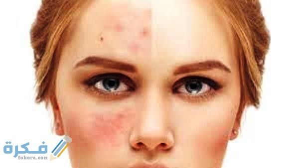 الخيار للتخلص من الحبوب