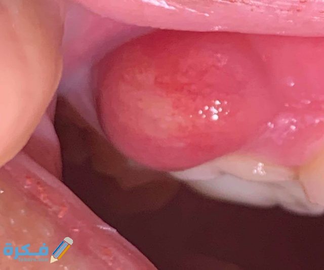 ما هو خراج اللثة ما هو خراج اللثة