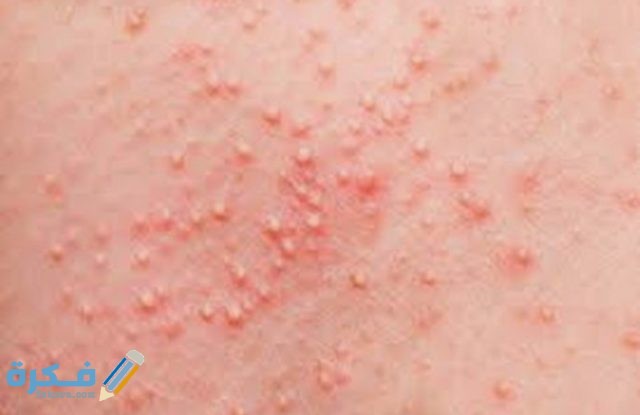 ظهور حبوب في الثدي IMG ٢٠٢٠٠٥١٥ ١٣١٤٠٩