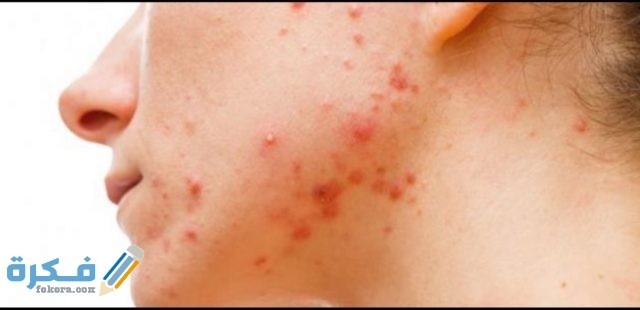 ظهور حبوب في الوجه ايام التبويض IMG ٢٠٢٠٠٥١٥ ١٦٢٩٠٦