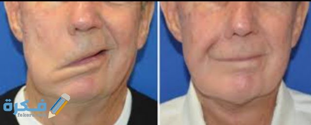 متى يشفي مريض الجلطة الدماغية IMG ٢٠٢٠٠٥١٧ ٢٣١٤٢١