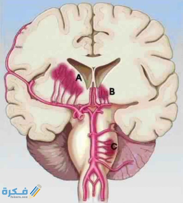 متى يتم الشفاء من نزيف المخ IMG ٢٠٢٠٠٥١٩ ١٥٢٣٥٣