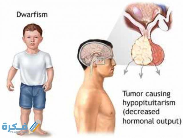 أعراض نقص هرمون النمو IMG ٢٠٢٠٠٥١٩ ١٦١٤١٠