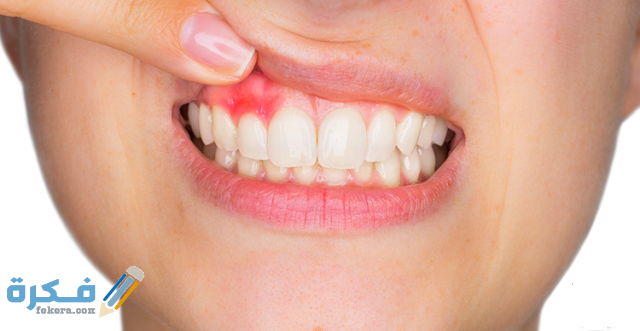 ما هو خراج الأسنان 