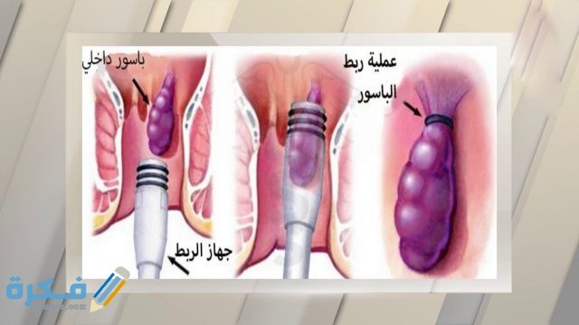 ما هي البواسير ما هي البواسير