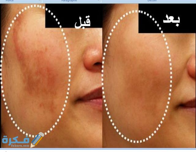 كلف الحمل وكيف يمكن التخلص الولادة