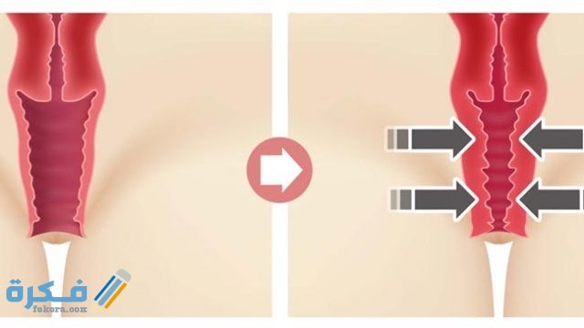 هي أفضل الطرق لتضييق المهبل بعد الولادة الطبيعية