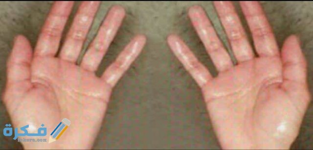 حل مشكلة تعرق اليدين باستمرار IMG ٢٠٢٠٠٨١٣ ١١٥٣١٤