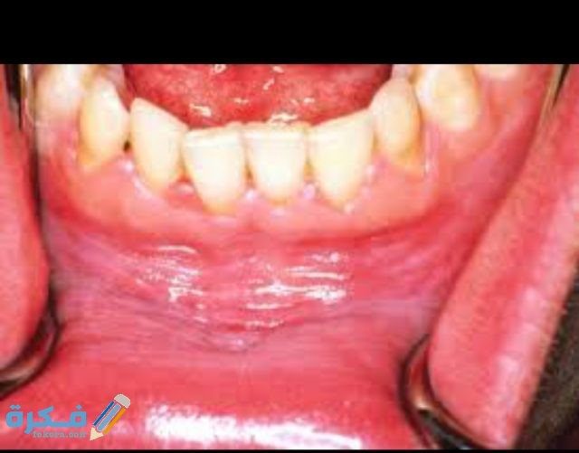 كيفية علاج التهاب اللثة الشديد في المنزل IMG ٢٠٢٠٠٨٢٨ ١٧٥٨٥٨