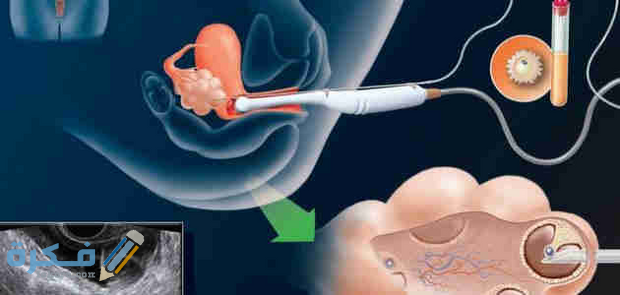 افضل دكتور اطفال انابيب في سوريا افضل دكتور اطفال انابيب في سوريا