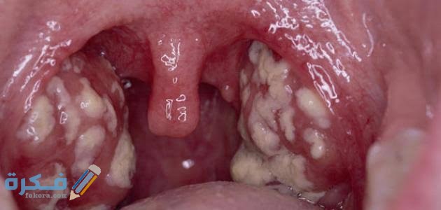 أفضل مضاد حيوي لالتهاب الحلق المزمن أفضل مضاد حيوي لالتهاب الحلق المزمن