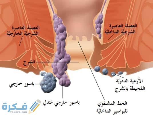 متى يلتئم الجرح بعد عملية البواسير متى يلتئم الجرح بعد عملية البواسير