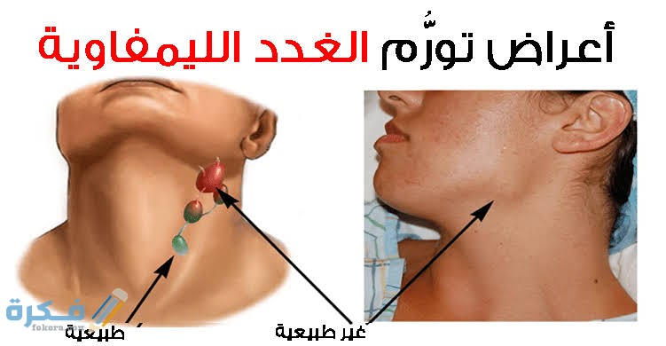 أفضل مضاد حيوي لالتهاب الغدد اللمفاوية أفضل مضاد حيوي لالتهاب الغدد اللمفاوية