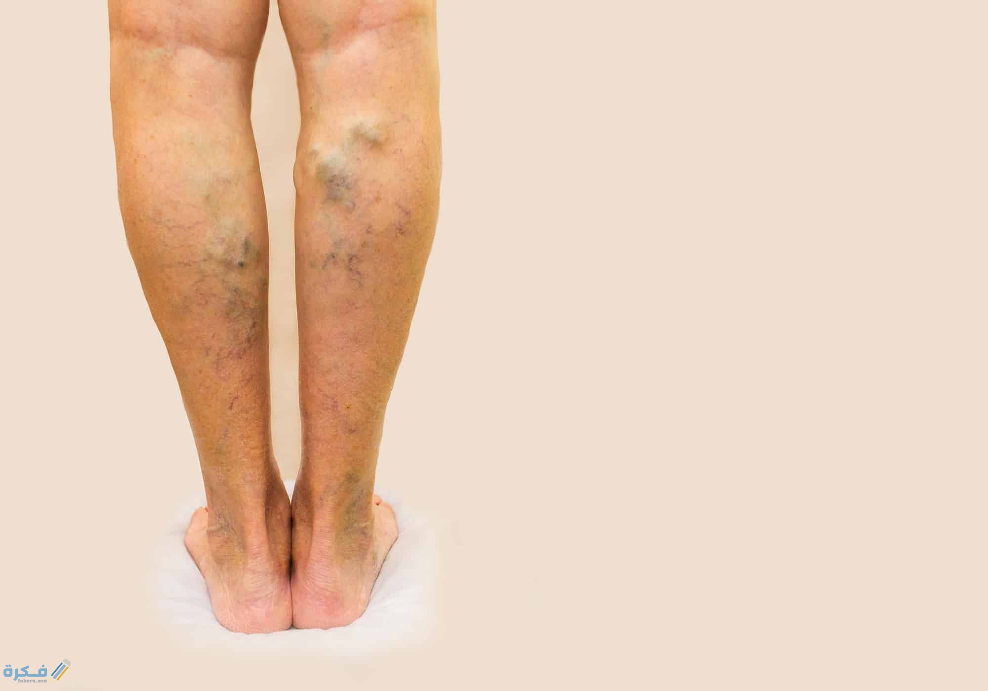 روشتة علاج الدوالي