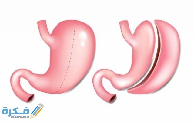 شروط عملية التكميم IMG ٢٠٢٠١١٠٧ ٢٣٤٧١٩