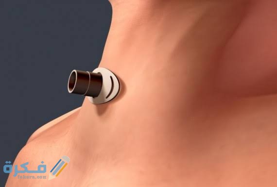 إجراء ثقب القصبة الهوائية إجراء ثقب القصبة الهوائية