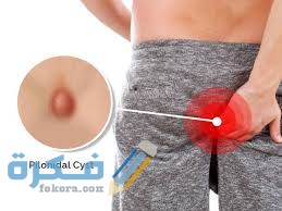 ما سبب ظهور حبة بجانب فتحة الشرج؟