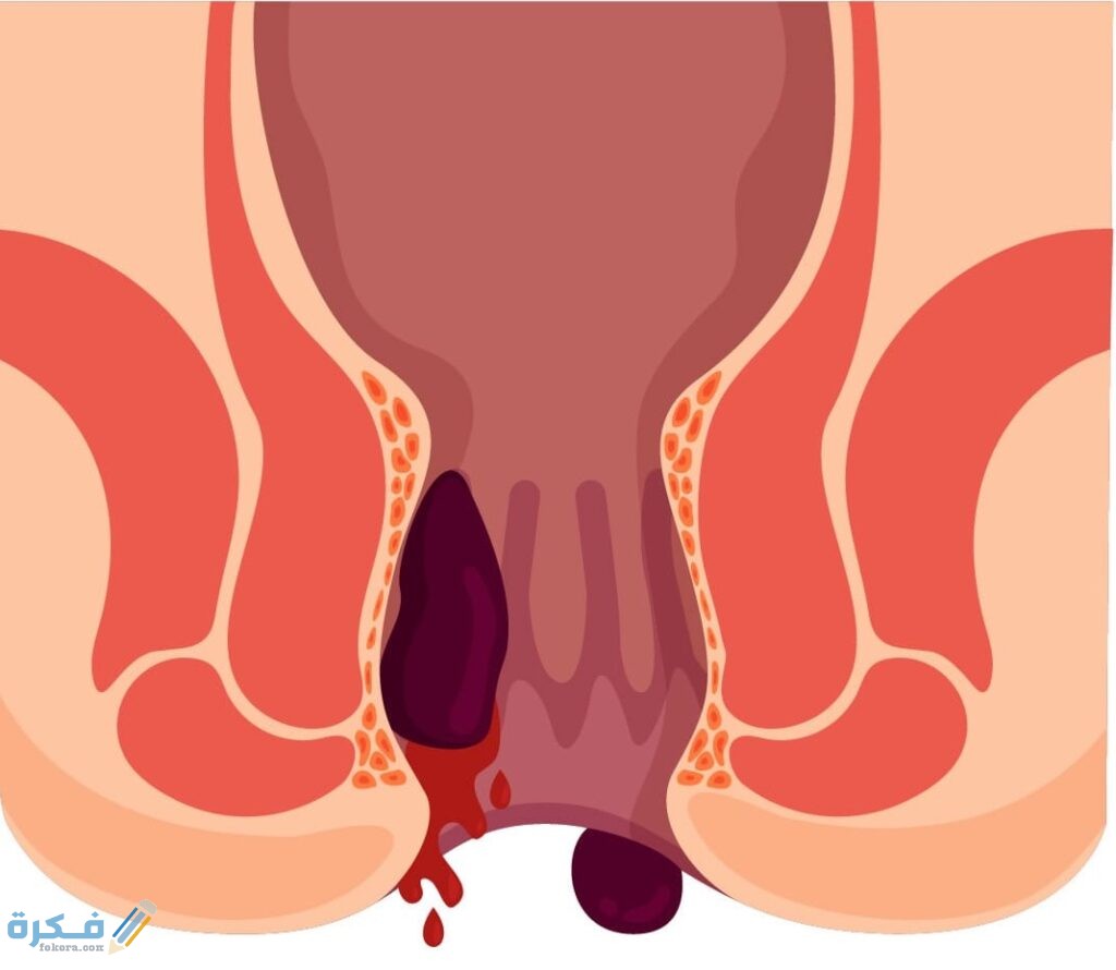 البواسير الخارجية 1024x890 1