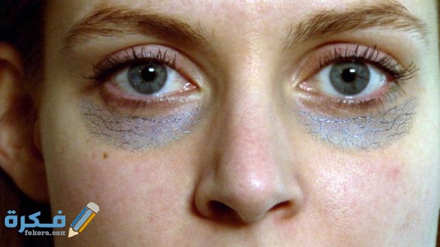 هَلْ نقص فيتامين د يسبب الهالات السوداء 16888844 403