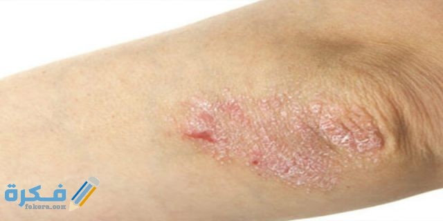 علاج الصدفية نهائياً بالأعشاب 6 questions answers about psoriasis